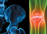 هشاشة العظام وسبل الوقاية الغذائية