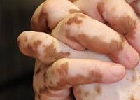 أسباب  مرض البهاق وطرق علاجه