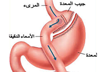 جراحة السمنة   ..  أنواعها ، ايجابياتها وسلبياتها