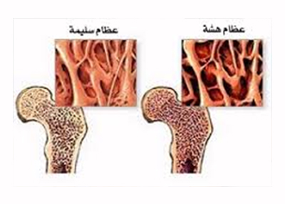 هشاشة العظام.. الأسباب وطرق العلاج