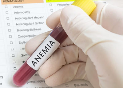 تعرف على أسباب وأعراض نقص الحديد عند النساء